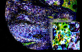 Head & Neck Squamous Cell Carcinoma: HPV- p16, CK5, EGFR, Vimentin, CD3, CD4, CD8, CD20 (1). Two-panel overlay, Tissue courtesy of Dr. Mark Lingen, University of Chicago.